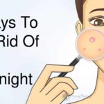 top 5 methods to remove pimples