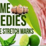 how to remove stretch marks at home